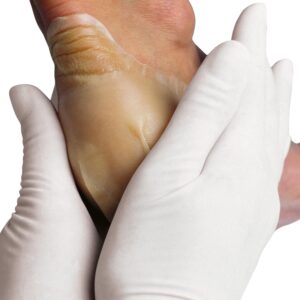 Alternative view of Hydrocoll (Similar to Granuflex) Hydrocolloid Dressing 15cm x 15cm (Singles)