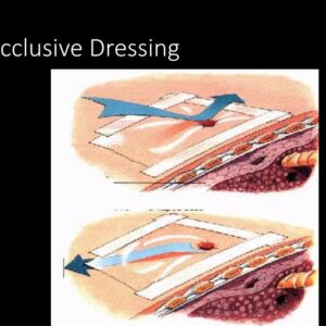 Flutter Valve (Occlusive Dressing)
